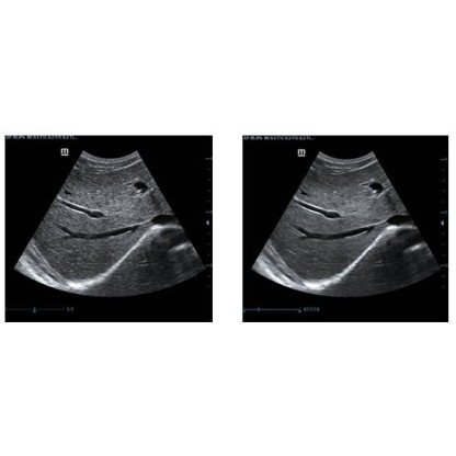 Sistema De Ultrasonido De 17' (Doppler Color) Con Transductor Lineal Convexo Endocavitario Sectorial